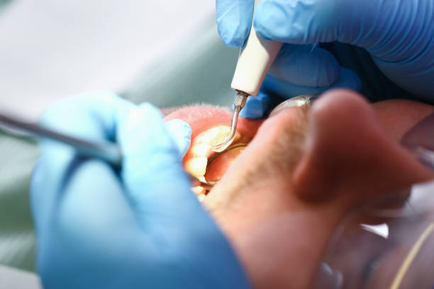 Best Emergency Dentist for Lost Fillings or Crowns in Germantown, WI